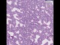 Histopathology Lung--Hyaline membrane disease Histopathology Lung--Hyaline membrane disease