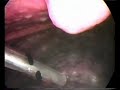 CTVA  derrame pleural Dr. Jorge Nazar