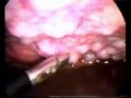 CTVA derrame pleural Dr. Jorge Nazar