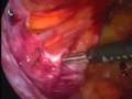 videos de Laparoscopic Hernia