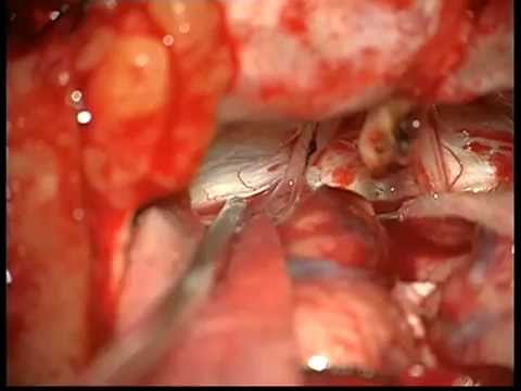 how to diagnose csf leak