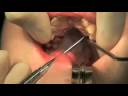 Titamed: Placement UNI-Smile Distractor