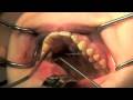 Placement UNI-Smile Distractor
