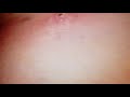 Cellulitis drainage - day 5