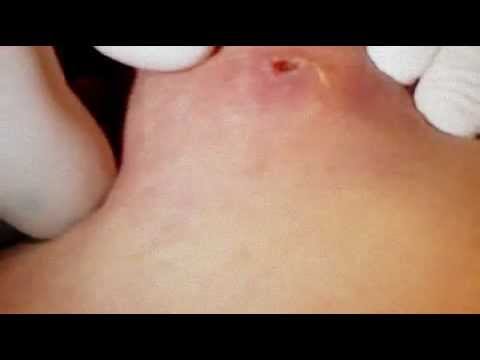 how to drain cellulitis