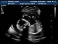 videos de Baby Sonogram