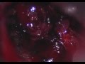 Pituitary tumor resection. Pituitary apoplexy.