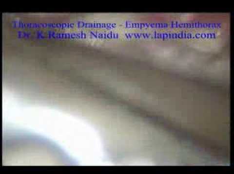Thoracoscopy Drainage Empyema Thorax ...