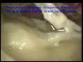 Thoracoscopy Drainage Empyema Thorax - Thoracoscopic Thoracoscopy Drainage Empyema Thorax - Thoracoscopic