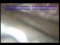 Thoracoscopy Drainage Empyema Thorax - Thoracoscopic