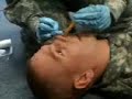 Nasal Nasogastric Tube Insertion