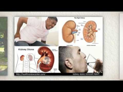 how to dissolve uric acid kidney stones