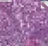 Histopathology Bone marrow--adenocarcinoma, metastatic