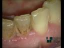 Igiene orale con microscopio-oral hygiene with a microscope- excellence dental network .avi