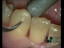 Igiene orale con microscopio-oral hygiene with a microscope- excellence dental network .avi