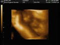 miguel licero garrido   3d ultrasound