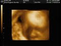 miguel licero garrido   3d ultrasound
