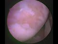 Inside my shoulder (Doc\