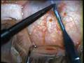 Crystal Lens Implant Crystal Lens Implant