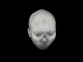 The anatomical images are performed by 3T-MRI, both 3D high resolution T1-weighted images and Diffusion spectrum imaging (DSI ) are acquired. 3D high resolution T1-weighted images enable to reconstruct into various sections, and is helpful in clinical diagnosis. The MRI images belong to a brain tumor patient. In T1-weighted images, a tumor mass is found at deep left frontal white matter. Using DSI-reconstructed tractography, we can evaluate the relationship between the tumor and white matter tracts. The tractography shows three different tracts: corticospinal tract (blue one), corpus callosum (red one), and cingulum (green one). As you can see, the middle part of corpus callosum is totally destroyed by the tumor and the cingulum is pushed into the contralateral side. The corticospinal tract is not effected.