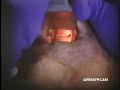 Grandview Laryngoscopy Blade