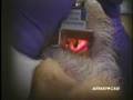 Grandview Laryngoscopy Blade