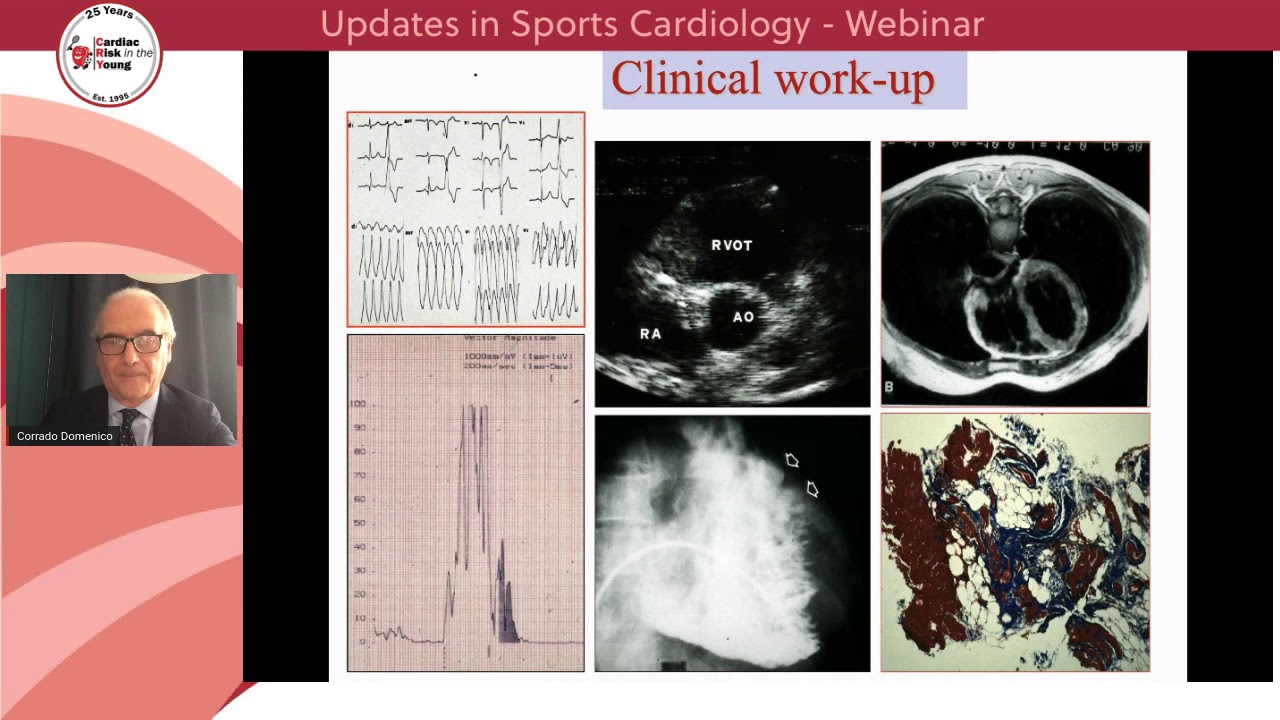 Ventricular ectopy in athletes made simple - Professor Domenico Corrado