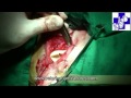 Los mucoceles son acúmulos de saliva que se producen bajo la mucosa o bajo la piel, se suelen producir por roturas del conducto salivar (traumáticas, tumorales,...). El tratamiento curativo de estas lesiones consiste en la extirpación de la/s glándulas tributarias así como la marsupialización del mucocele.