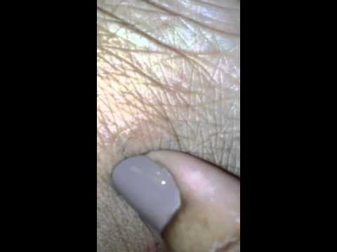 how to relieve sand gnat bites