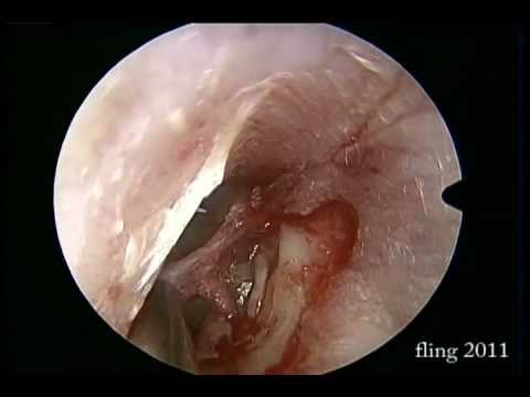 Incudostapedial Dislocation Endoscopic Repair