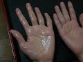 オドレミンを使って手汗を止めました。