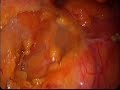 Disección mesorrectal con Ligasure Disección mesorrectal con Ligasure