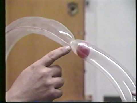 Balloon Angioplasty and Heart ...