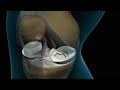 Lifenet Tissue Graft Knee Cartilage