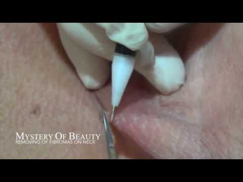 how to get rid of sebaceous hyperplasia