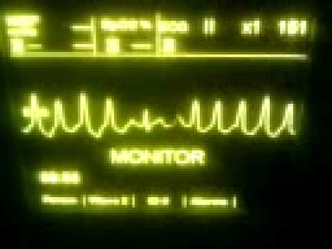 how to treat runs of v tach