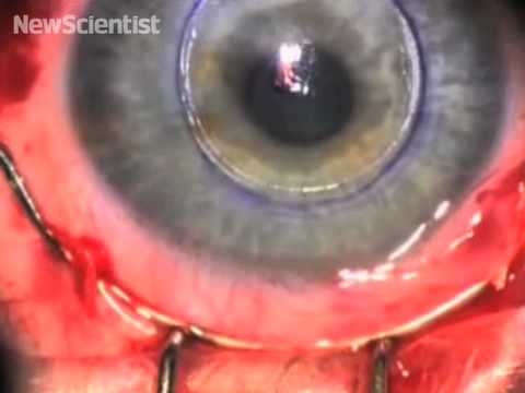 Biosynthetic Cornea 