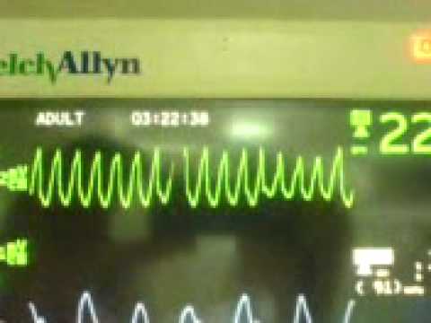 how to treat non sustained v tach