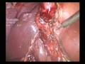 acute cholecystitis
