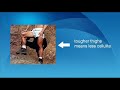 Anti Cellulite Treatment Anti Cellulite Treatment