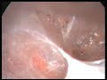 laparoscopic-inguina