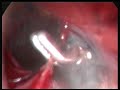 laparoscopic inguinal hernia repair Laparoscopic Hernia Repair