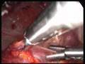 laparoscopic inguinal hernia repair