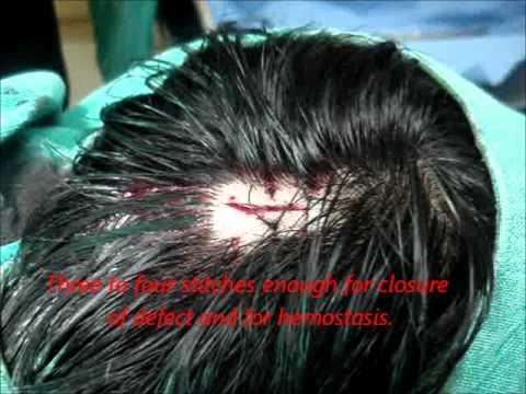 how to control warts