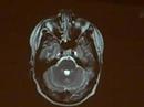 Normal Transverse MRI 2