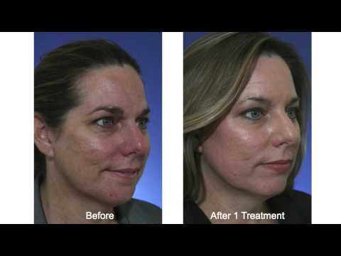 Acne Scar Treatment with Fractional CO2 Laser