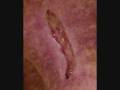 videos de Radionecrosis treated with HBOT at HOPE