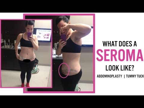 how to drain after tummy tuck