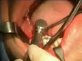 Dente giudizio incluso - intervento chirurgico
