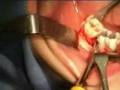 Dente giudizio incluso - intervento chirurgico